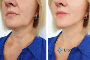 Double chin before and after Hi-Fu treatment 4 Book your double chin treatment Newcastle today! We are here to help!