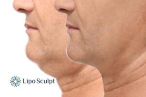 Double chin before and after Hi-Fu treatment 2 Double chin treatment Newcastle from Lipo Sculpt - feel more confident today!