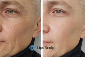 How to Fight Aging Symptoms 3 Fight Aging Symptoms Newcastle With HIFU and Morpheus8 Today!