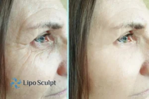How to Fight Aging Symptoms 2 Do you want to Fight Aging Symptoms Newcastle? Contact Lipo Sculpt today!