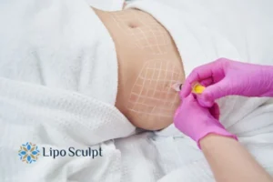 Are The Results From Aqualyx Permanent? 1 Do you want to know how long Aqualyx Newcastle results last?