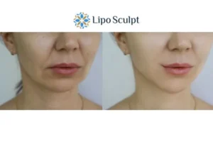 Explaining Total Skin Tightening Treatment And What It Can Do For You 2 Do you want to boost your self confidence? Give Morpheus8 Newcastle a try today!