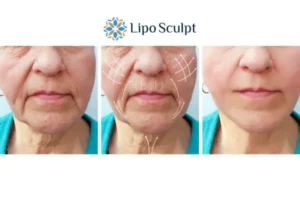 Explaining Total Skin Tightening Treatment And What It Can Do For You 3 Boost your confidence with Morpheus8 Newcastle call our team today!