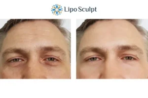 Explaining Total Skin Tightening Treatment And What It Can Do For You 6 Morpheus8 Newcastle book in today to find out more!