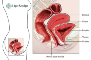Treatment For A Leaky Bladder 2 How EM Chair treatment Newcastle can help Leaky bladder issues. Read more now!