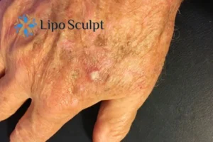 Best Actinic Keratoses Removal 2 Improve your wellbeing and health with Actinic Keratoses Newcastle removal.treatment