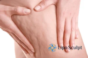 CoolSculpting for Legs: The Innovative Approach to Redefining Your Legs 5 Start your journey today book your coolsculpting treatment Newcastle online today!