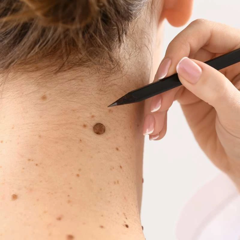 See our lesion removal prices Newcastle - call today for a free quote