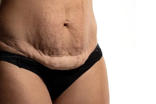 Lost the Weight but Not the Loose Skin? 1 image of womans stomach after weight loss showing loose skin Newcastle